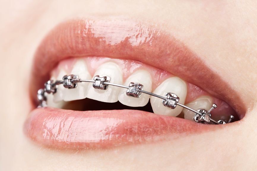 Amit a fogszabályozásról tudni érdemes (2. rész)